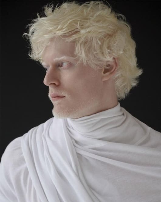 An albino human. Source: Pinterest
